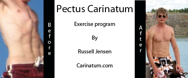 Pectus Carinatum Non Surgery Workouts and Exercises for Bodybuilding